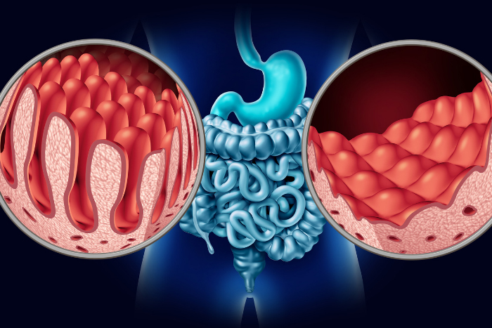 Enfermedad de Crohn y Colitis Ulcerosa