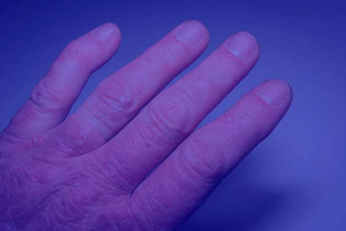 Psoriasis y Artritis Psoriásica