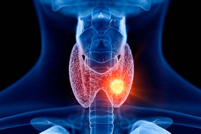 Tiroiditis Autoinmune